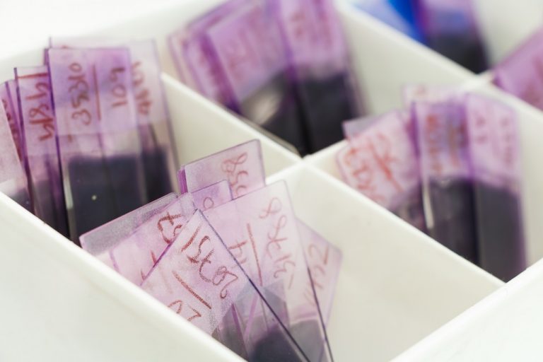 Hemofilia tratamiento vida media extendida