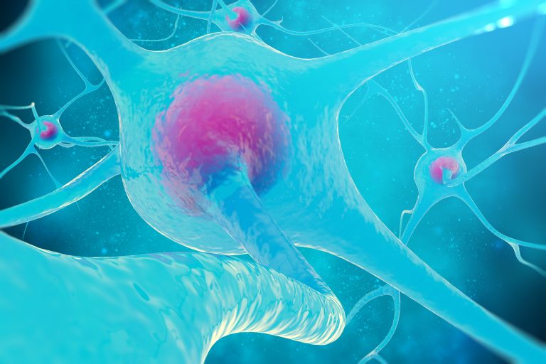 ALT=Causas del Alzheimer