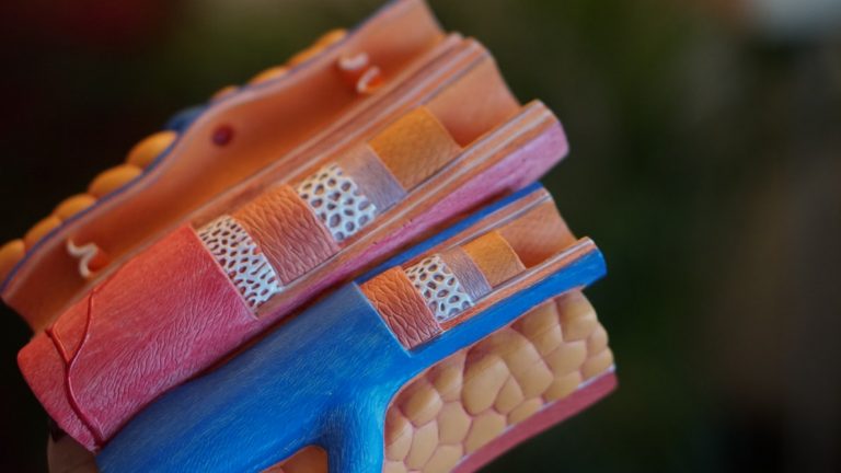 Si tienes entre 40 y 50 años podrías tener aterosclerosis y no saberlo