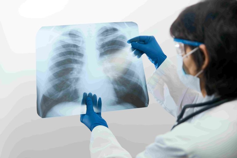 Placa torácica neumonía