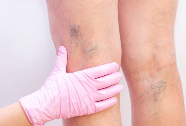 Diferencias entre varices y arañas vasculares