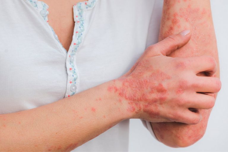 Álimentación y psoriasis
