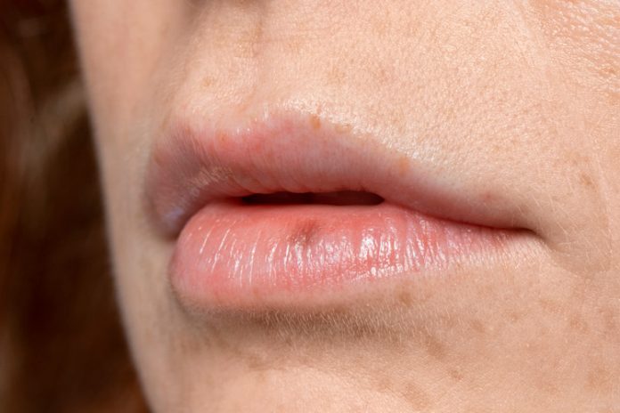 Prevenir Herpes Labial