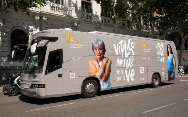 El vitíligo, más que un problema estético